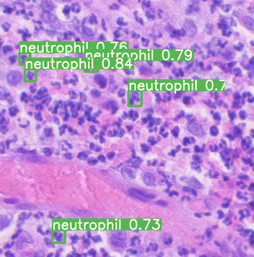 Image of a slide with white blood cells in it and five neutrophil identified.